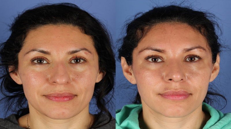 What Can a Nose Surgeon in Naperville Do For You?