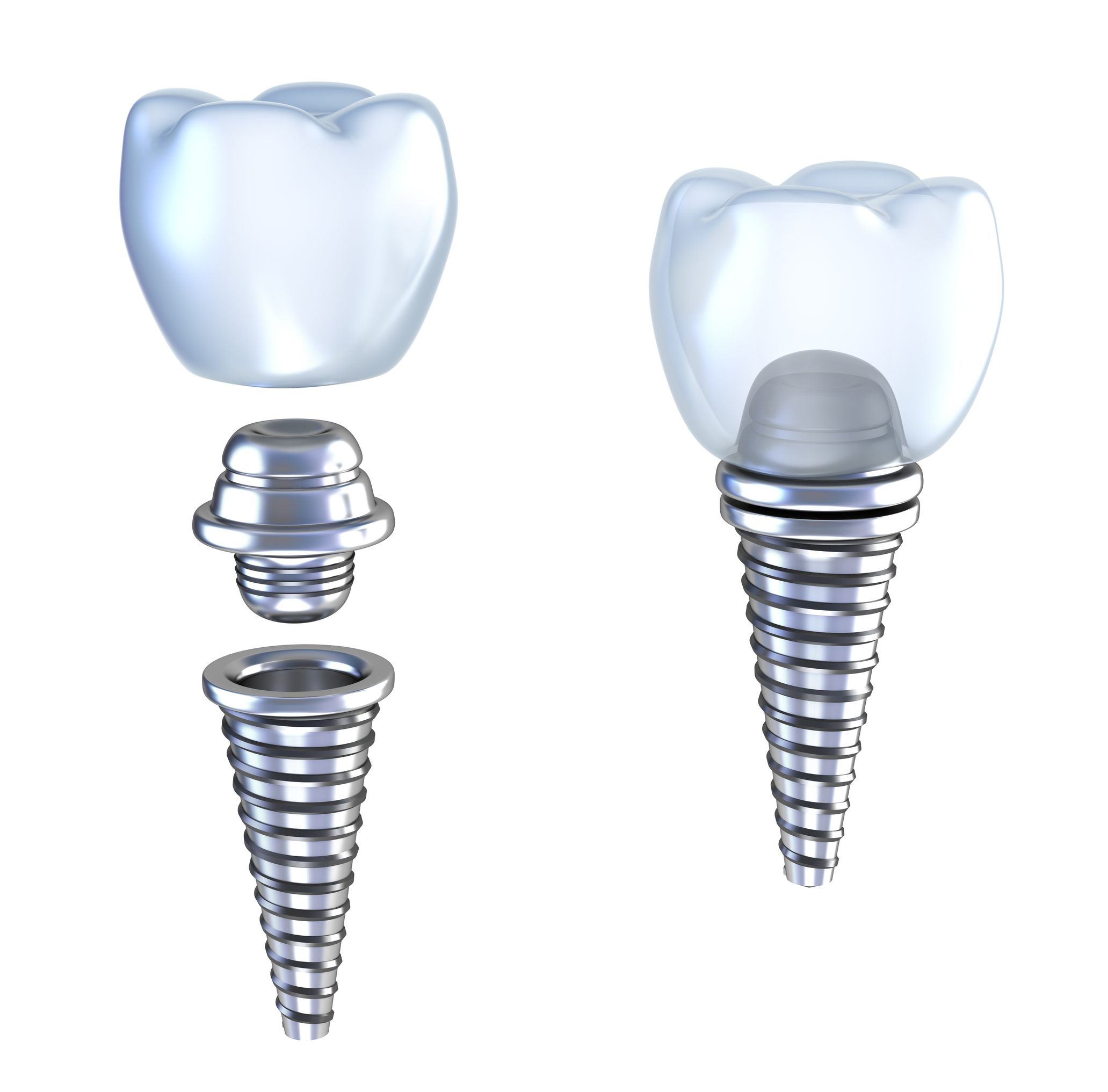 How Dental Implants Dentures in Panama City, FL Can Help You