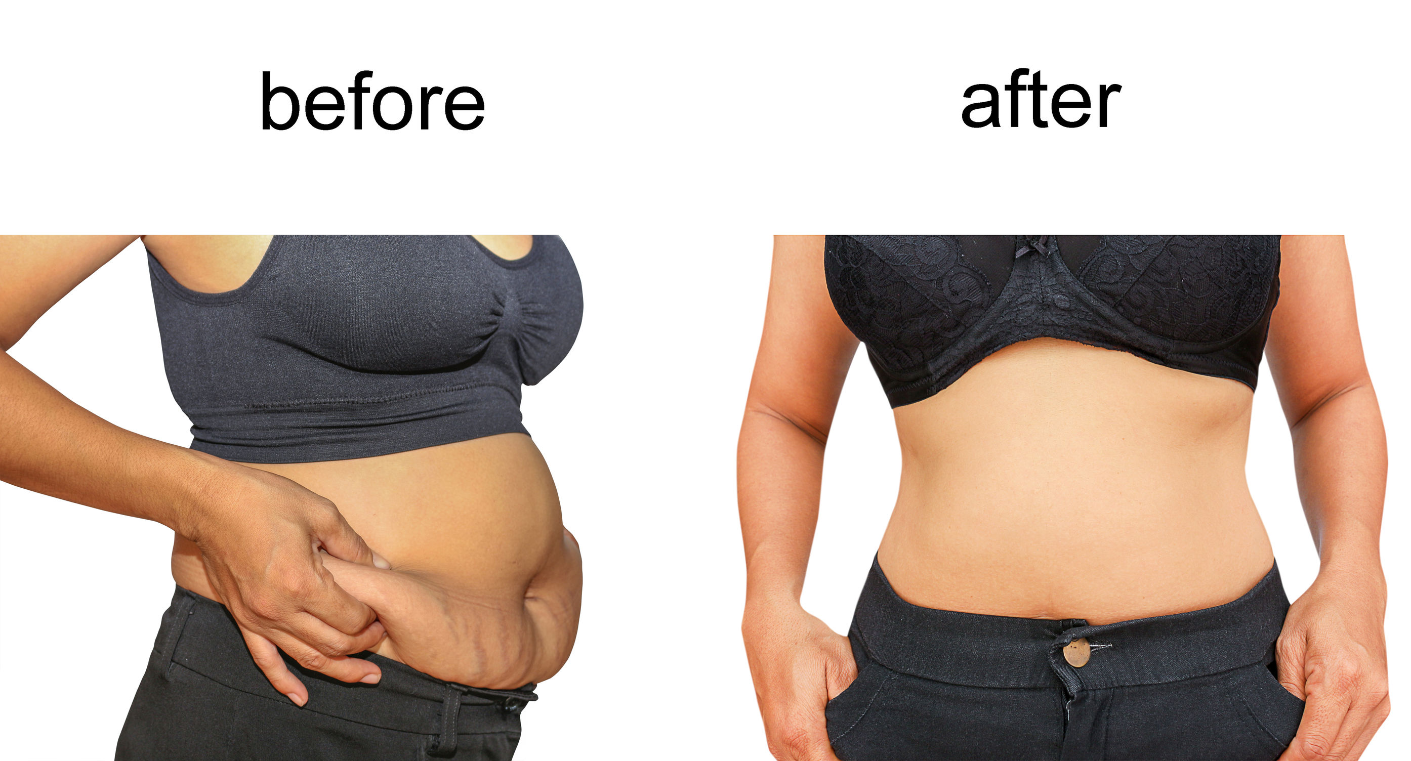 Liposuction in Orange County may be the Answer for Instant Fat Loss