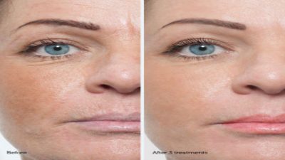 Do You Want a Facelift, Get Professional Help near Lincoln Park